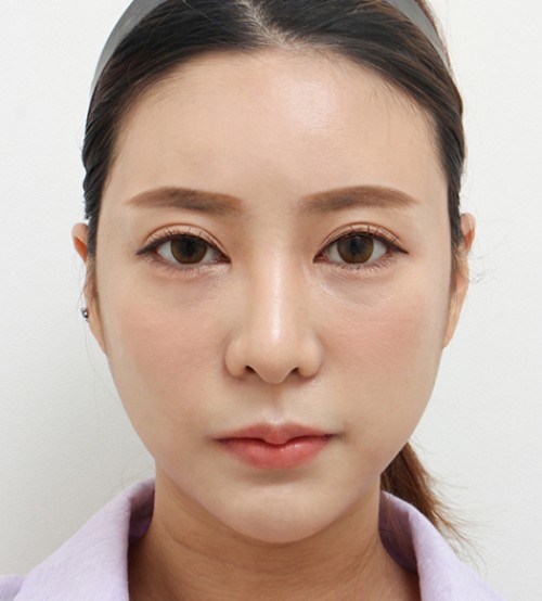 面部吸脂