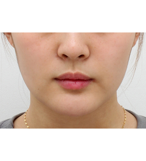 Before Image