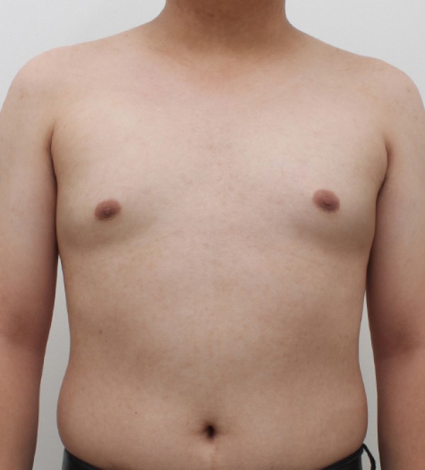 男性乳房发育症