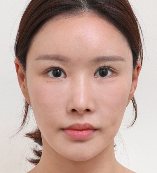 钙化、脂肪囊肿副…