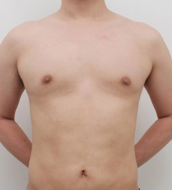 男性乳房发育症