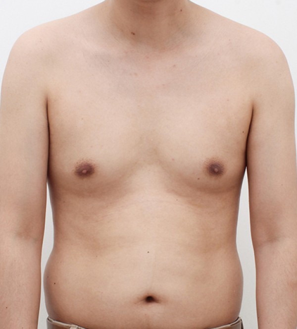 男性乳房发育症