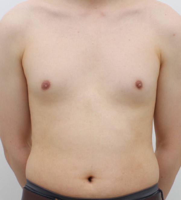 男性乳房发育症