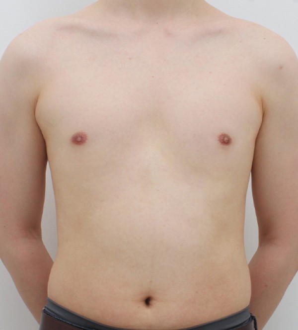男性乳房发育症