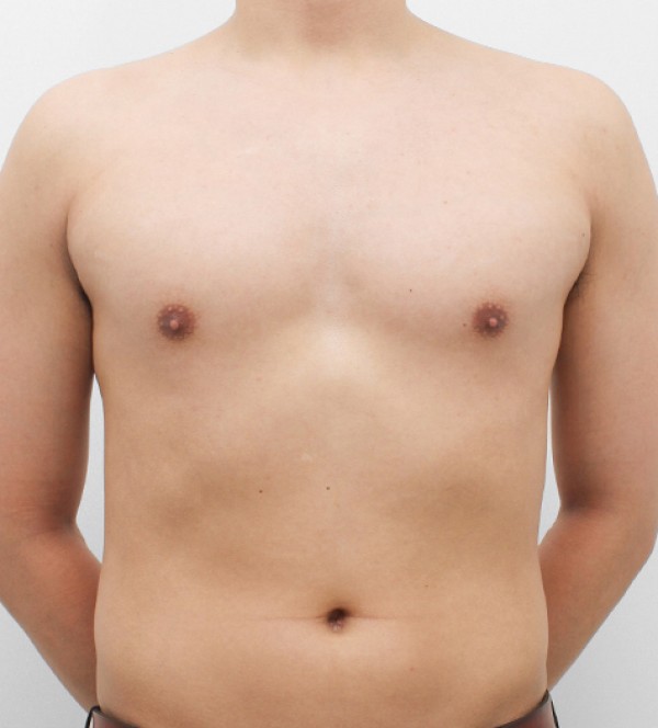 男性乳房发育症