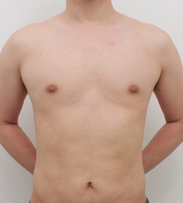 男性乳房发育症