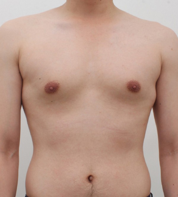 男性乳房发育症