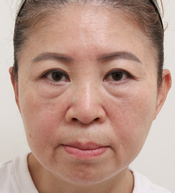 迷你拉皮