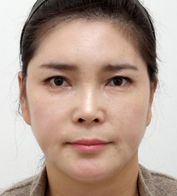 钙化、脂肪囊肿副…