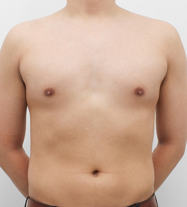 男性乳房发育症