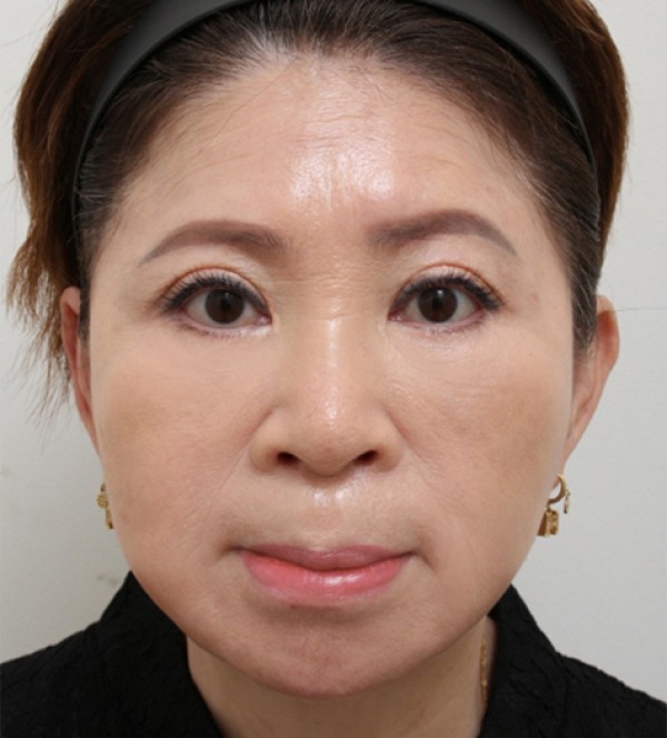 迷你拉皮