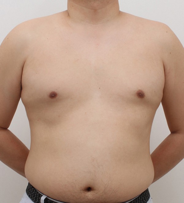 男性乳房发育症