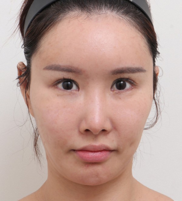 钙化、脂肪囊肿副…