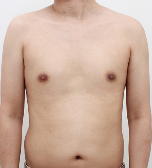 男性乳房发育症