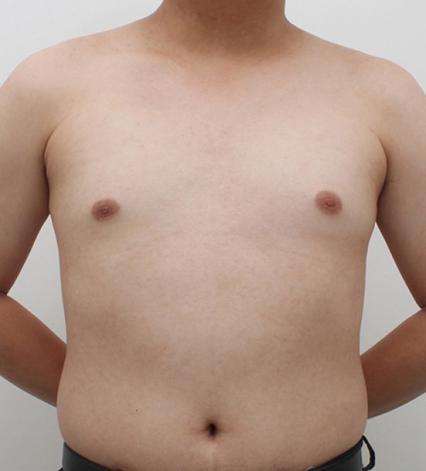 男性乳房发育症