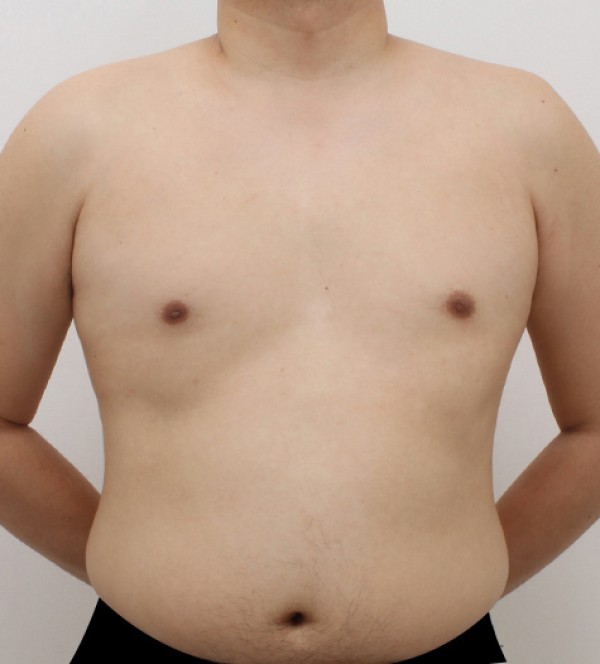 男性乳房发育症