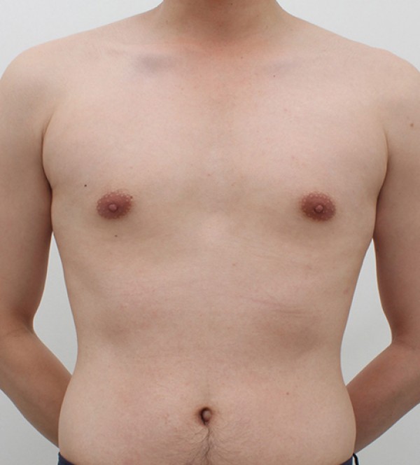 男性乳房发育症