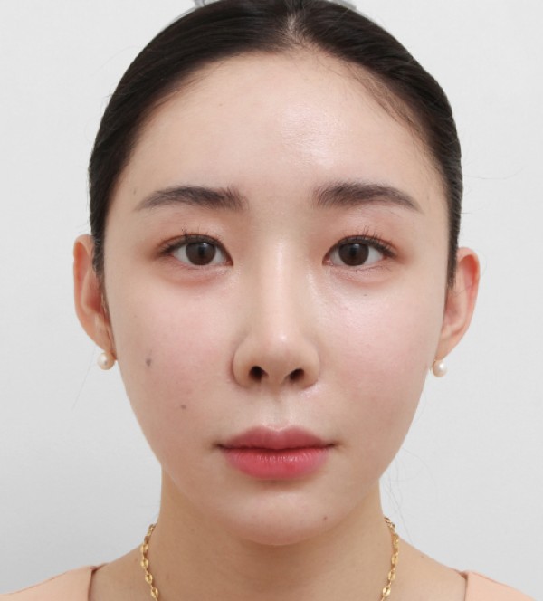 面部脂肪移植