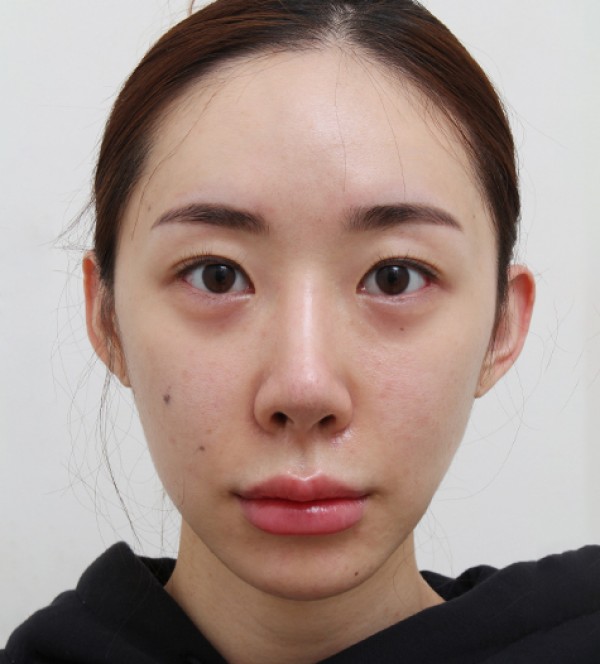 面部脂肪移植