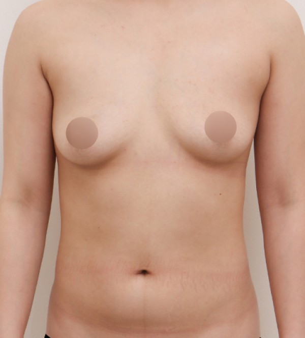 中年胸部整形