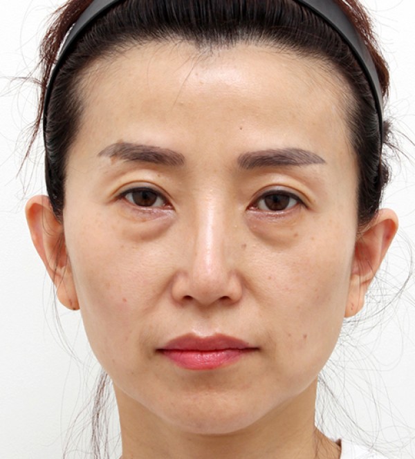 中年脂肪移植