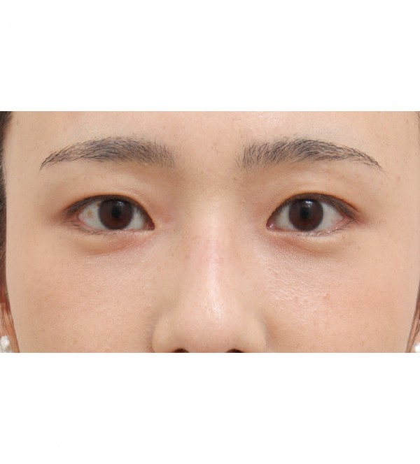 激光 眼底脂肪重…