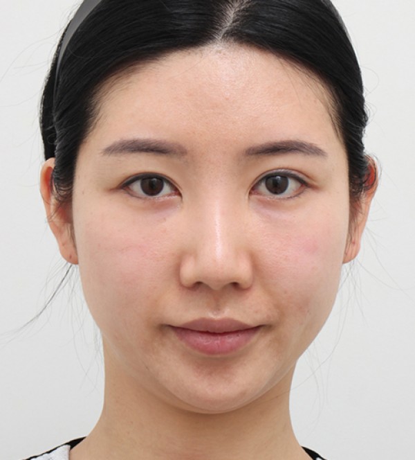 面部吸脂