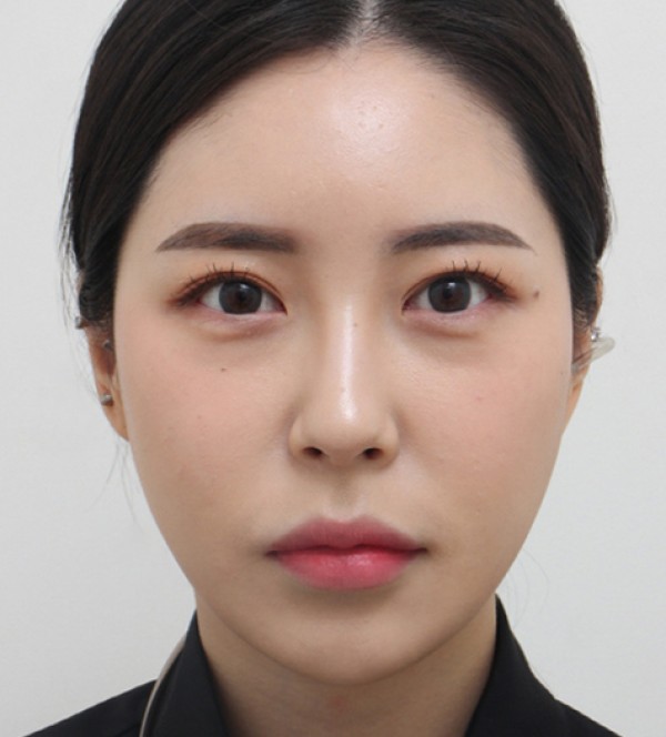 中年面部吸脂
