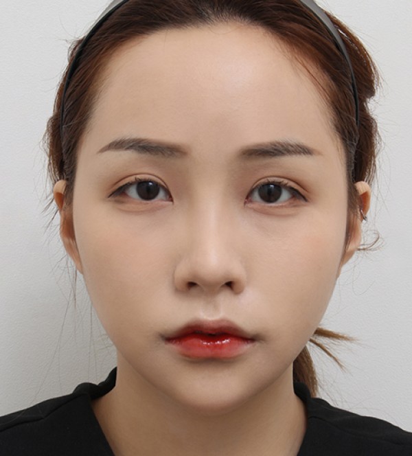 面部吸脂