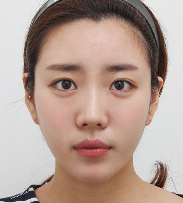 面部脂肪移植
