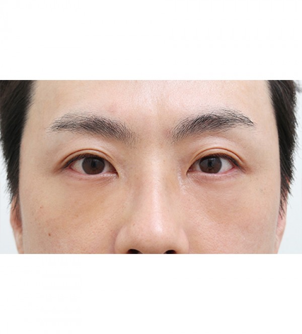 激光 眼底脂肪重…