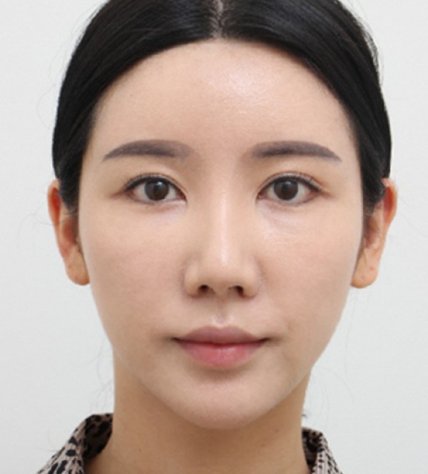 面部吸脂