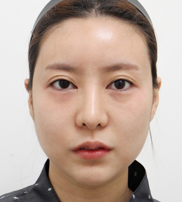 面部吸脂