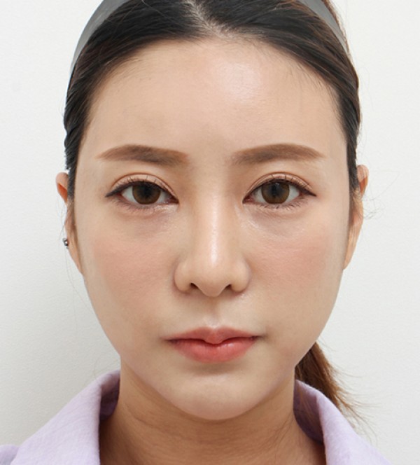 面部吸脂