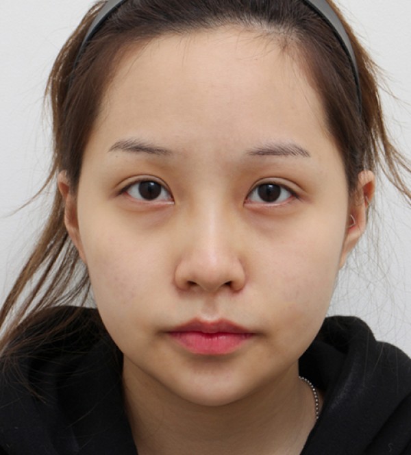 面部吸脂