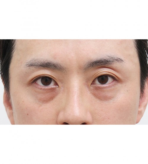 激光 眼底脂肪重置