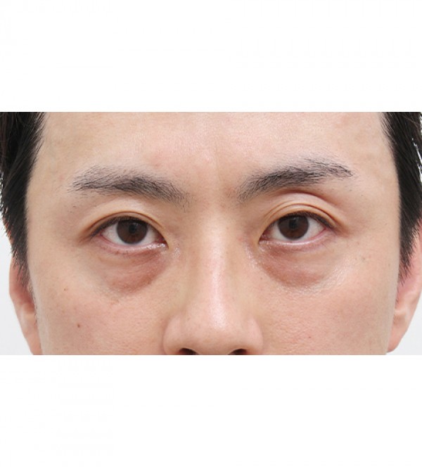 激光 眼底脂肪重…