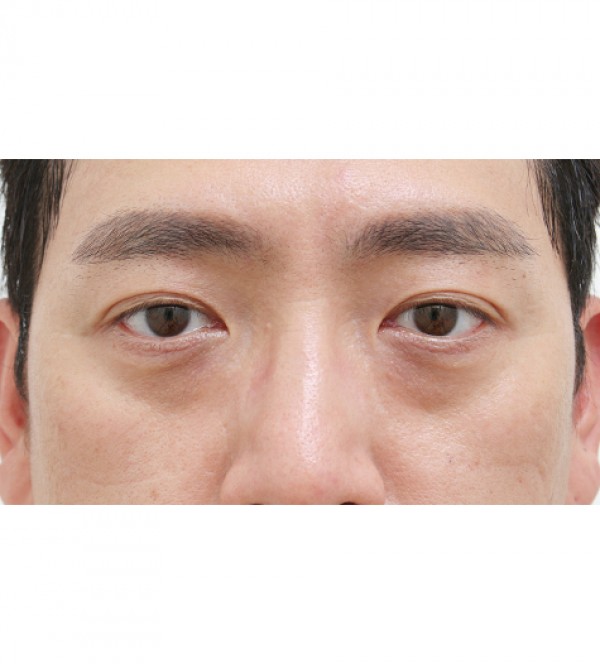 激光 眼底脂肪重…