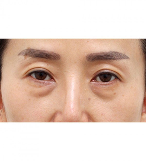 激光 去除眼底脂…
