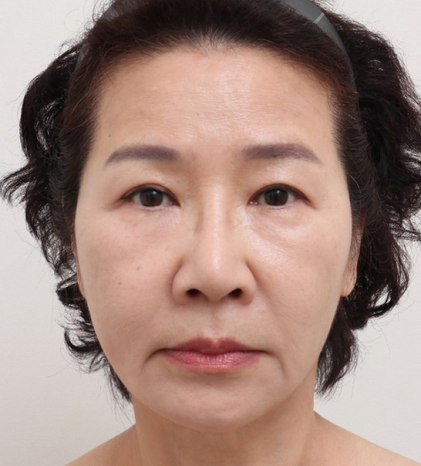 迷你拉皮