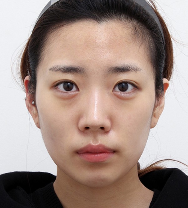 面部脂肪移植