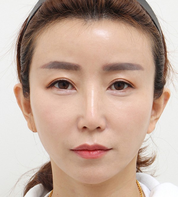 中年脂肪移植