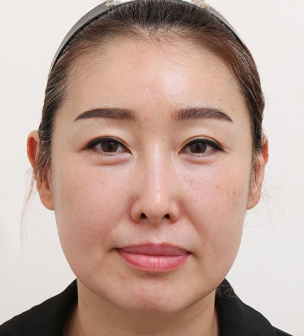 中年面部吸脂