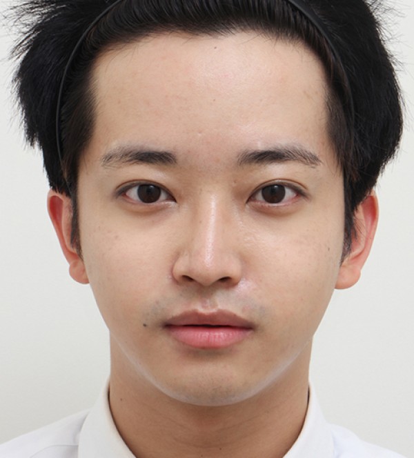 面部脂肪移植