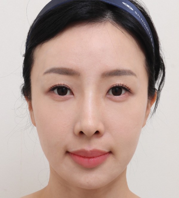 中年脂肪移植