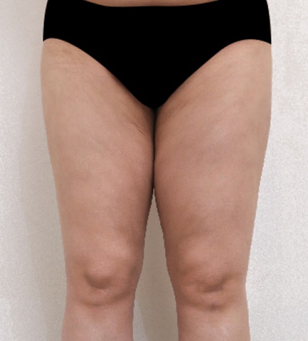 威塑2 身体吸脂