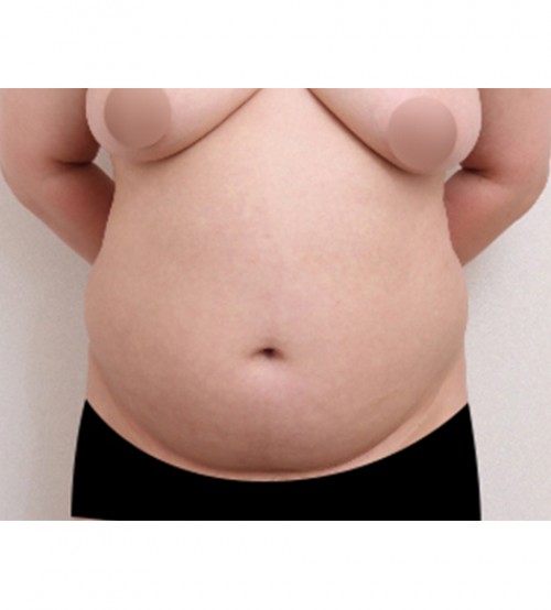 威塑2 身体吸脂