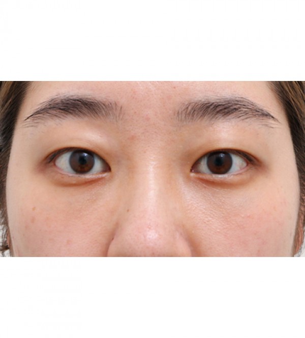 激光 眼底脂肪重…