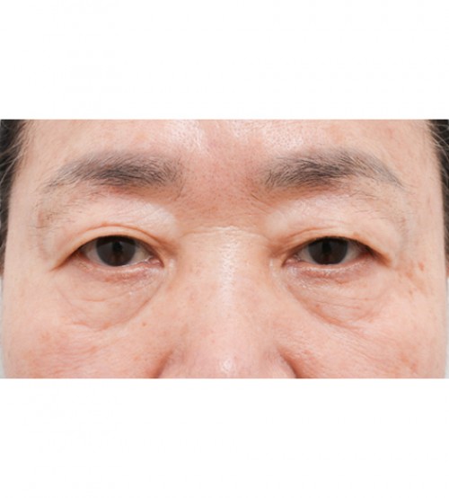 中年眼部整形