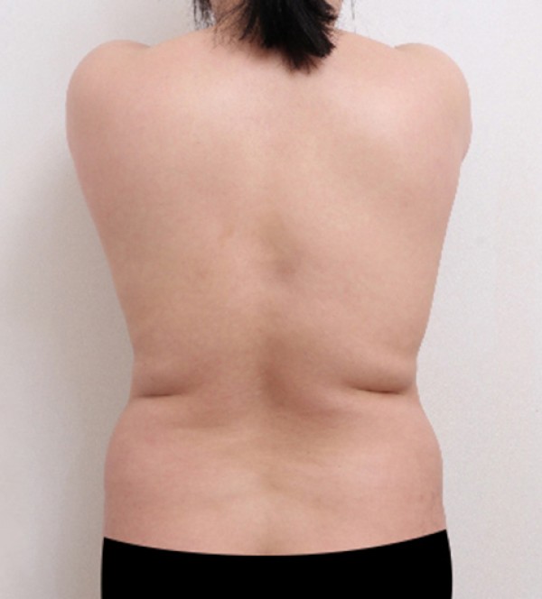 威塑2 身体吸脂